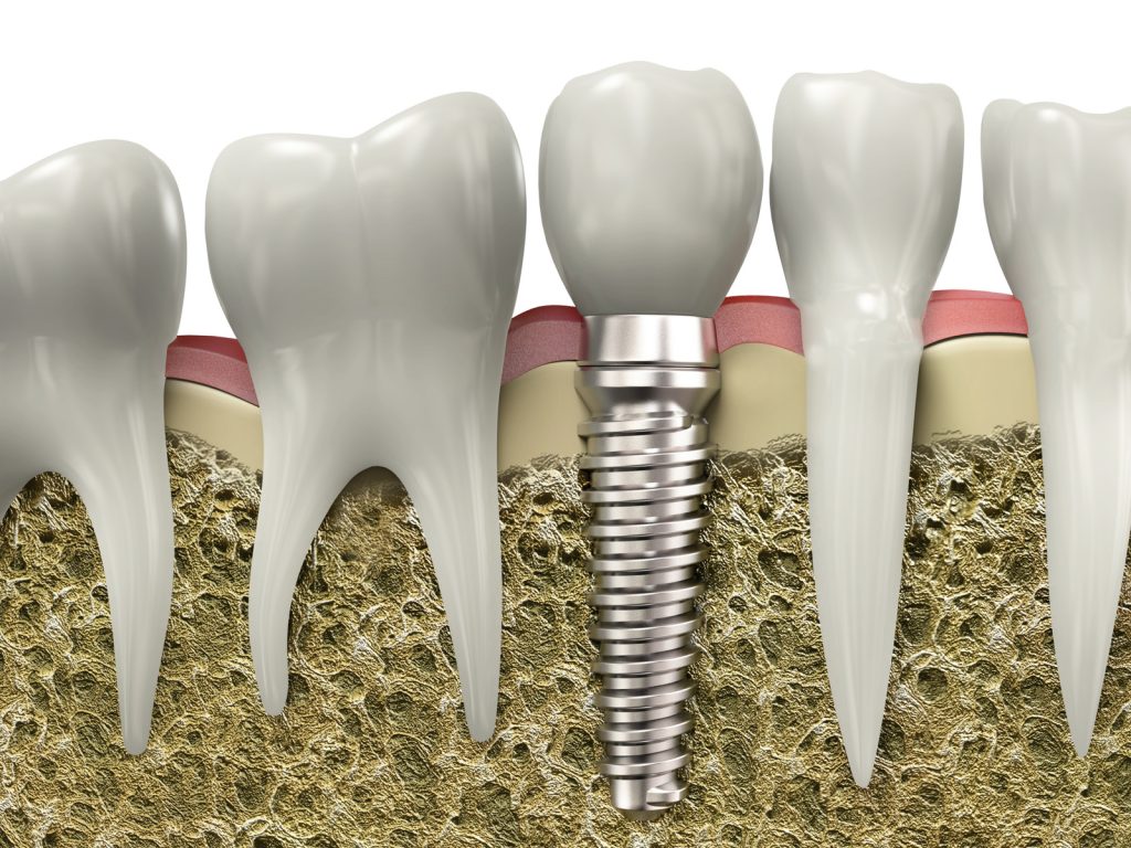 Dental Implants: A Path to Sustainable Oral Health