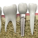 Dental Implants: A Path to Sustainable Oral Health