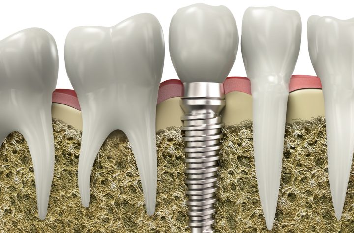 Dental Implants: A Path to Sustainable Oral Health